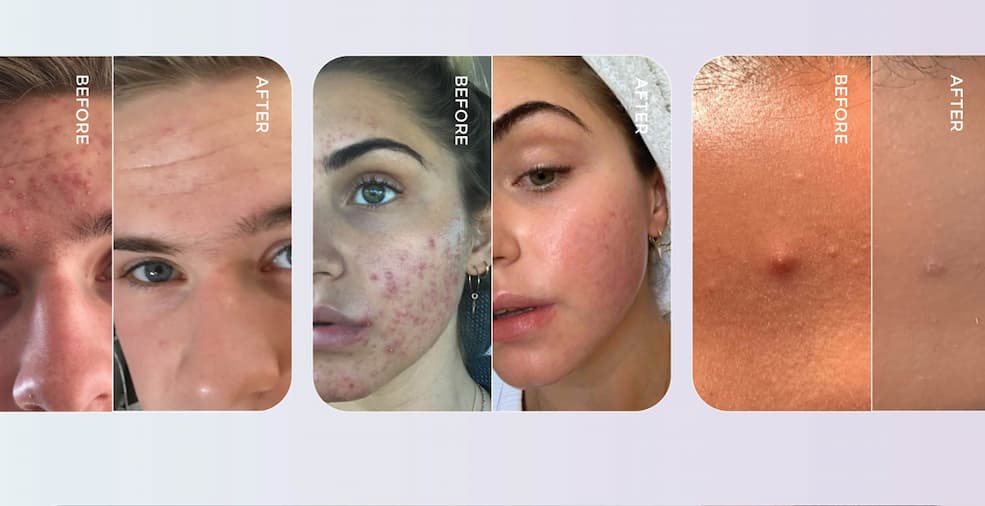 Acne Kit