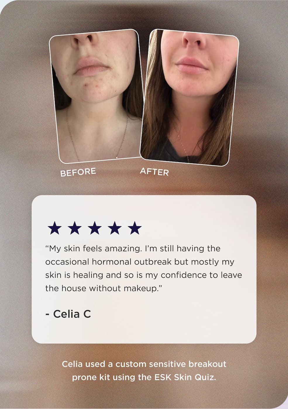 Acne Kit