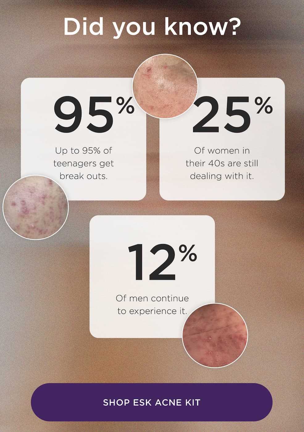 Acne Kit