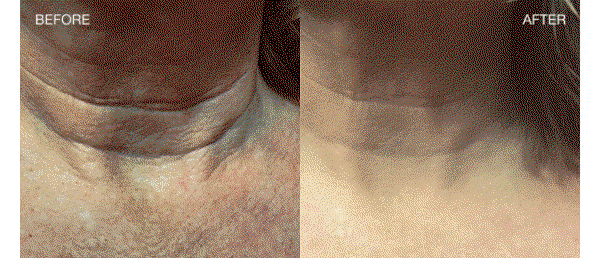 "No Needles, No Surgery, No Kidding."