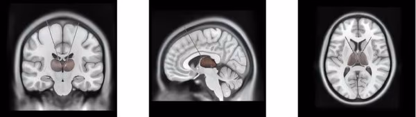 What separates dreaming from deep sleep? Brain rhythm offers new clue to consciousness | Medical Xpress