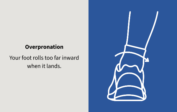 Overpronation