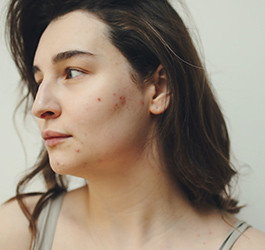 Acne: Everything you need to know