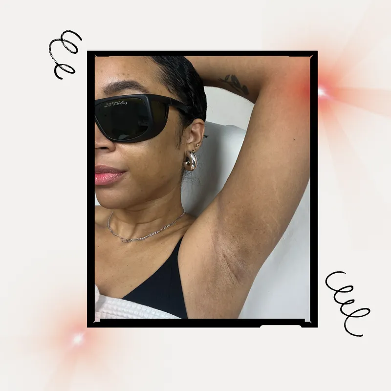 How I'm Preventing Hyperpigmentation During Laser Hair Removal
