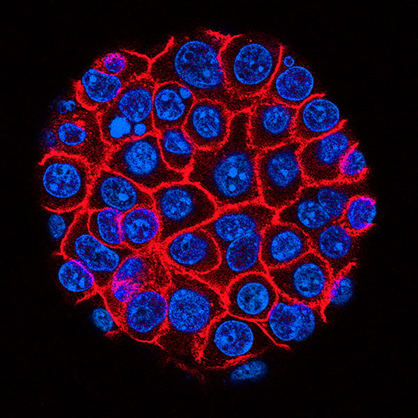 A fluorescent micrograph image of pancreatic cancer cells.