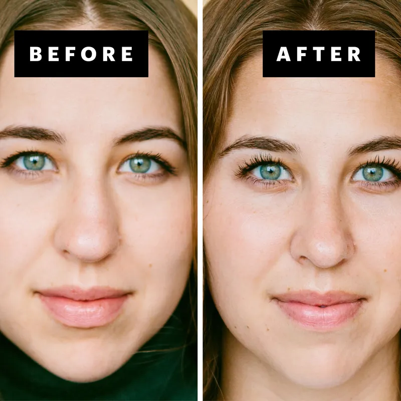 I Got a Nose Job Eight Years Ago—and This Is How I Feel About It Today