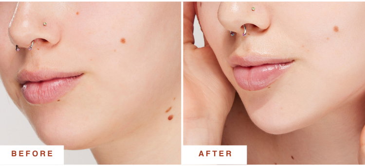 before and after on lips