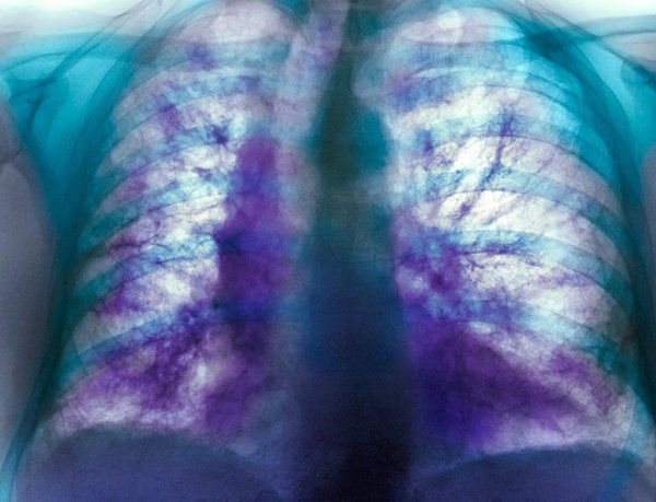 Coloured X-ray of the chest of a person with idiopathic pulmonary fibrosis. Large areas of scarring can be seen in purple.