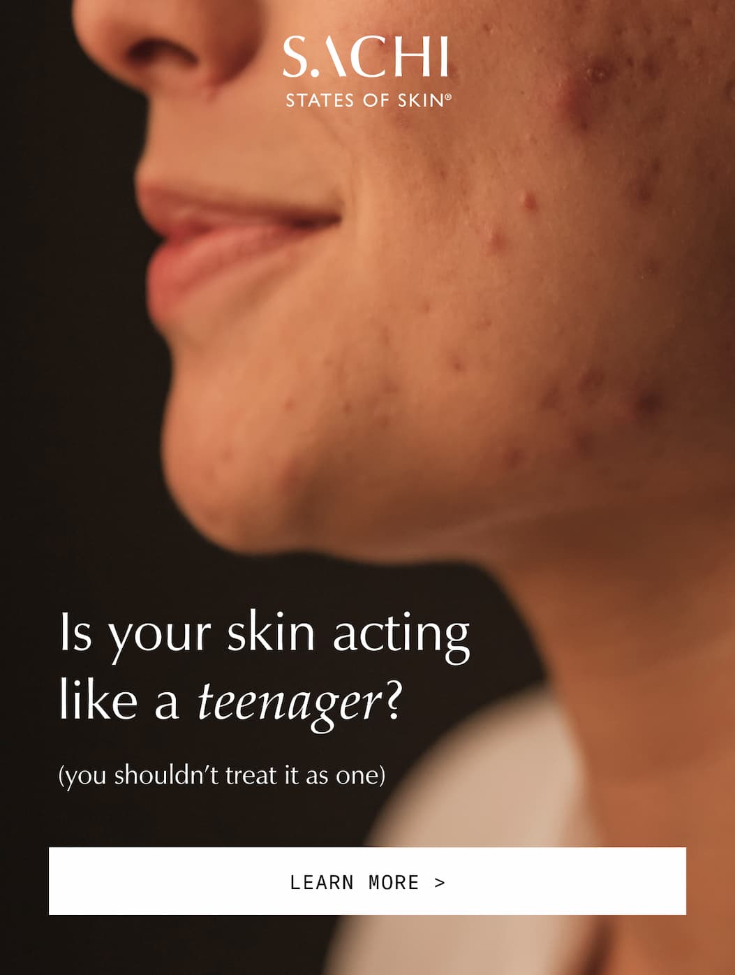 Is your skin acting like a teenager?