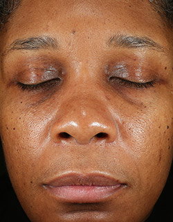 Woman's face with uneven and dehydrated skin