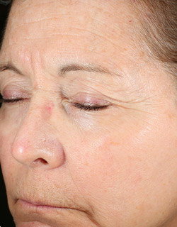 Woman's face with discoloration and dull looking skin