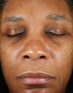 Same woman's face with even and hydrated skin