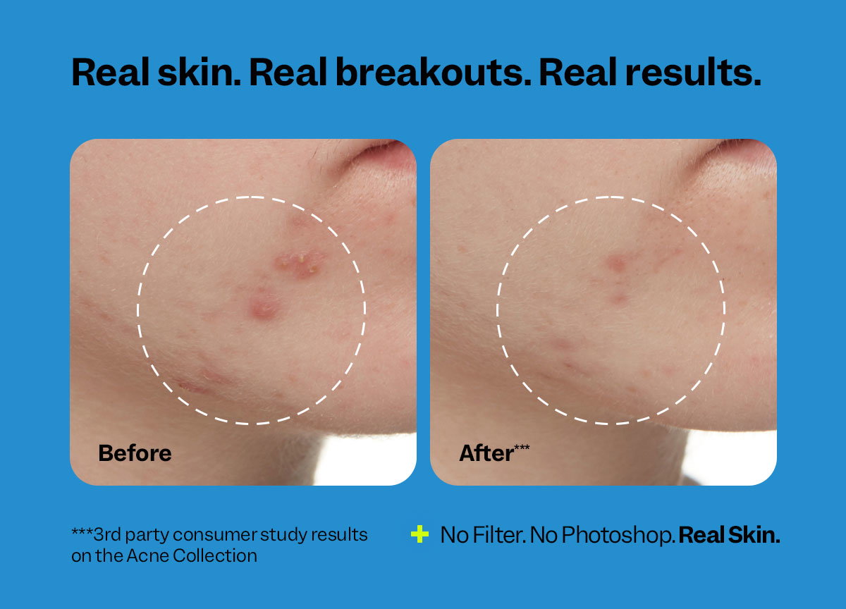 Real skin. Real breakouts. Real results.