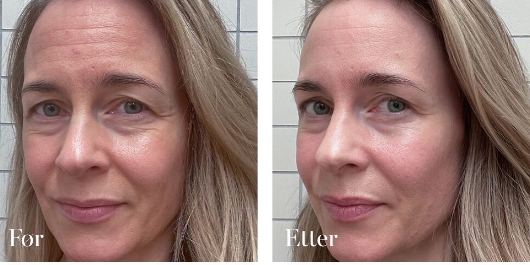 Before and After