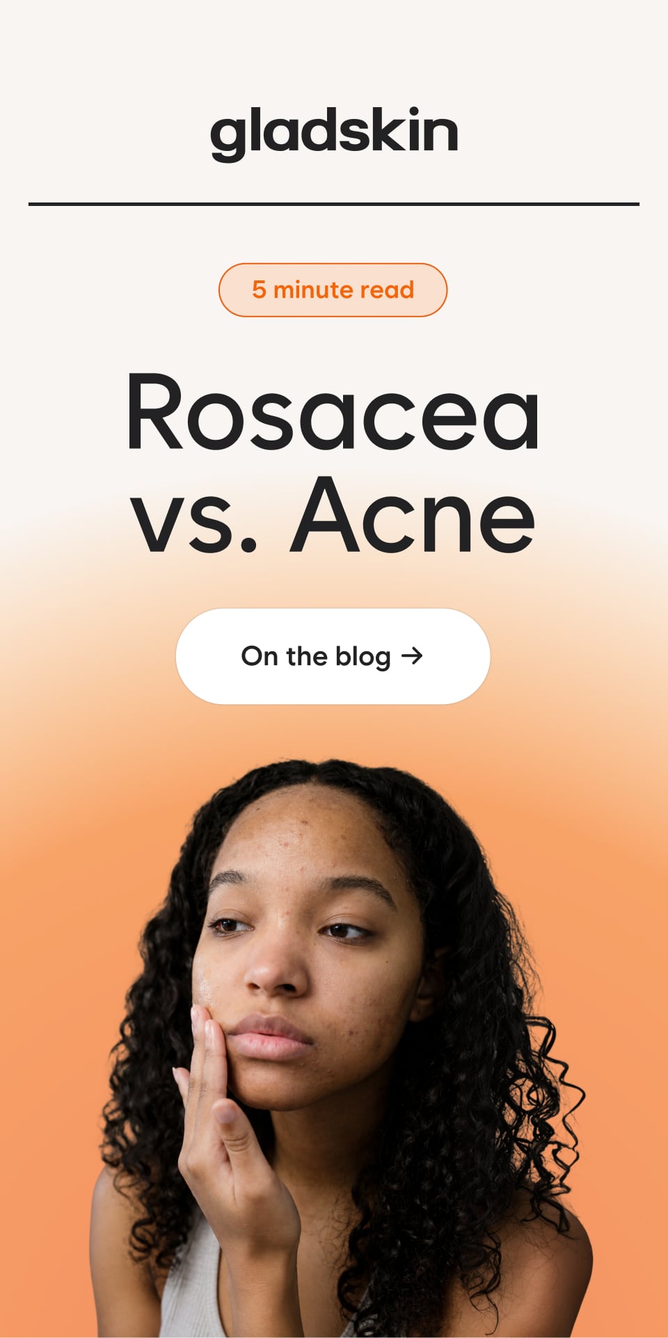 Rosacea vs. Acne On the Blog → 