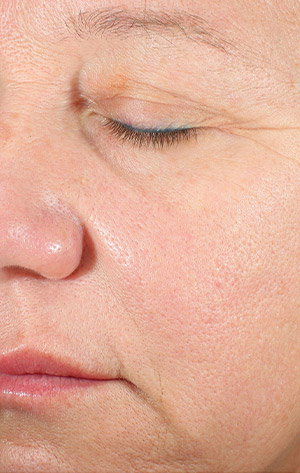 Same face with improved appearance of pores and skin elasticity