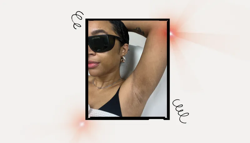 Image of beauty writer Aimee Simeon undergoing laser hair removal