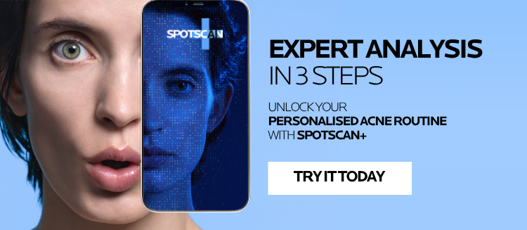 Person using Spotscan mobile tool for acne analysis