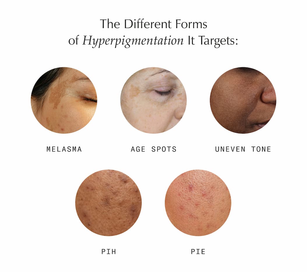 The Different Forms of Hyperpigmentation It Targets:
