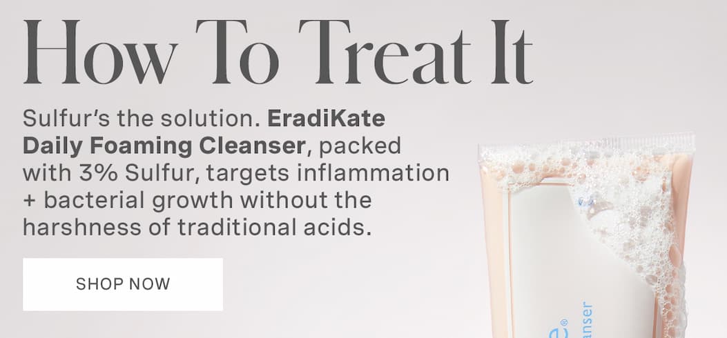 How To Treat It | Sulfur's the solution. EradiKate Daily Foaming Cleanser, packed with 3% Sulfur, targets inflammation + bacterial growth without the harshness of traditional acids. | SHOP NOW