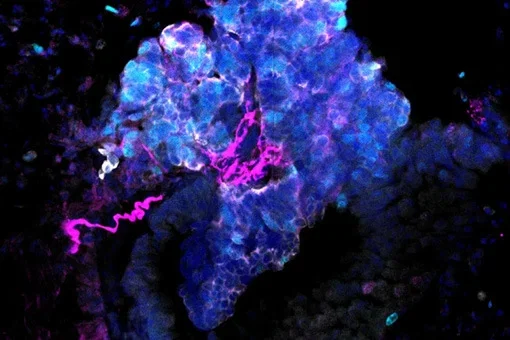 How the connection between lung cancer and the brain could lead to better treatments