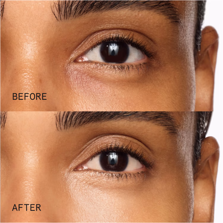 Before & After using Superluminous Under-Eye Genius