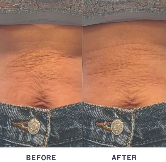 Before and After using M4 Body Treatment.