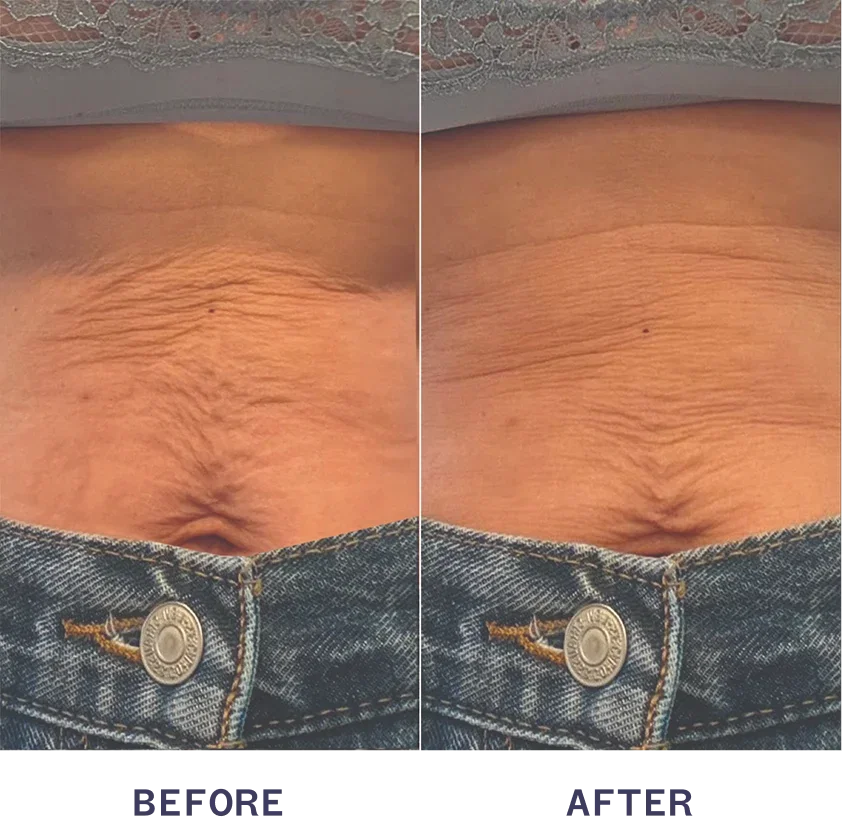 Before and After using M4 Body Treatment.