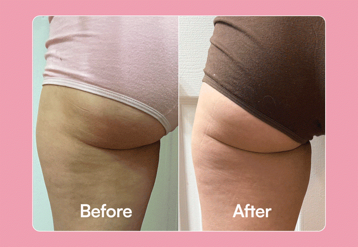 Before - After