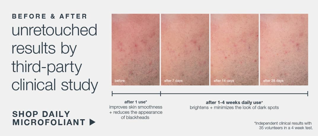 before + after | unretouched results by third party clinical study | daily microfoliant | results after 4 weeks