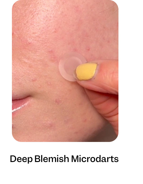 Deep Blemish Microdarts