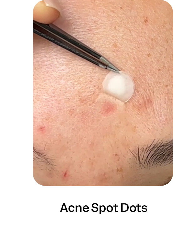 Acne Spot Dots