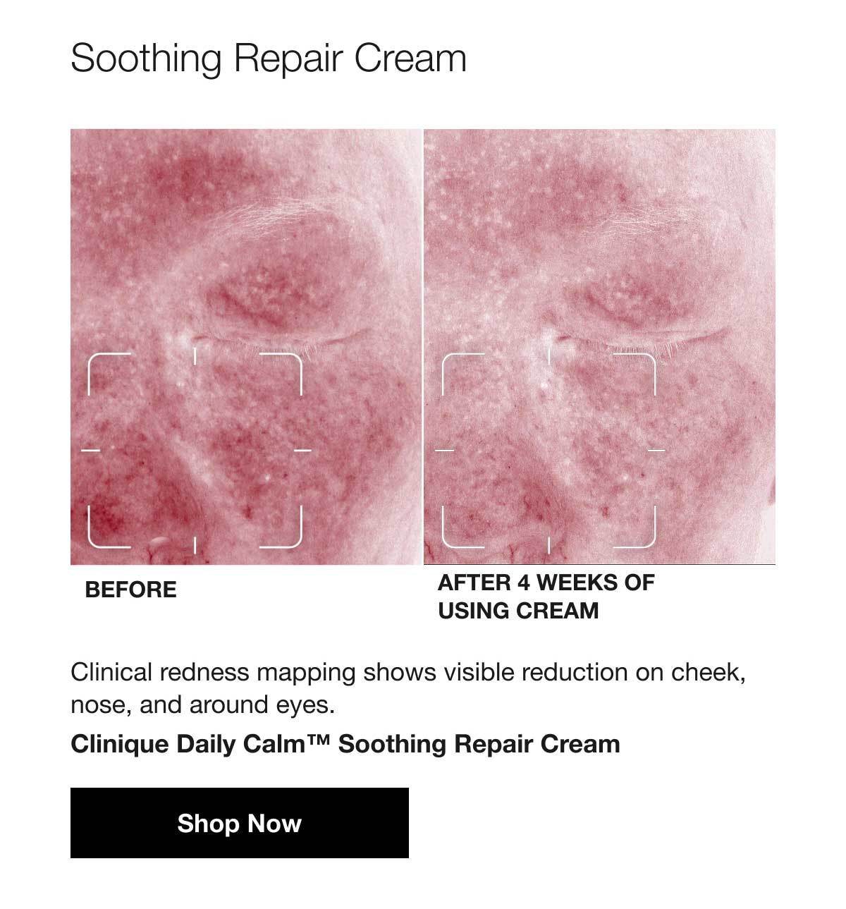 Soothing Repair Cream | BEFORE | AFTER 4 WEEKS OF USING CREAM | Clinical redness mapping shows visible reduction on cheek, nose, and around eyes. Clinique Daily Calm™ Soothing Repair Cream | Shop Now