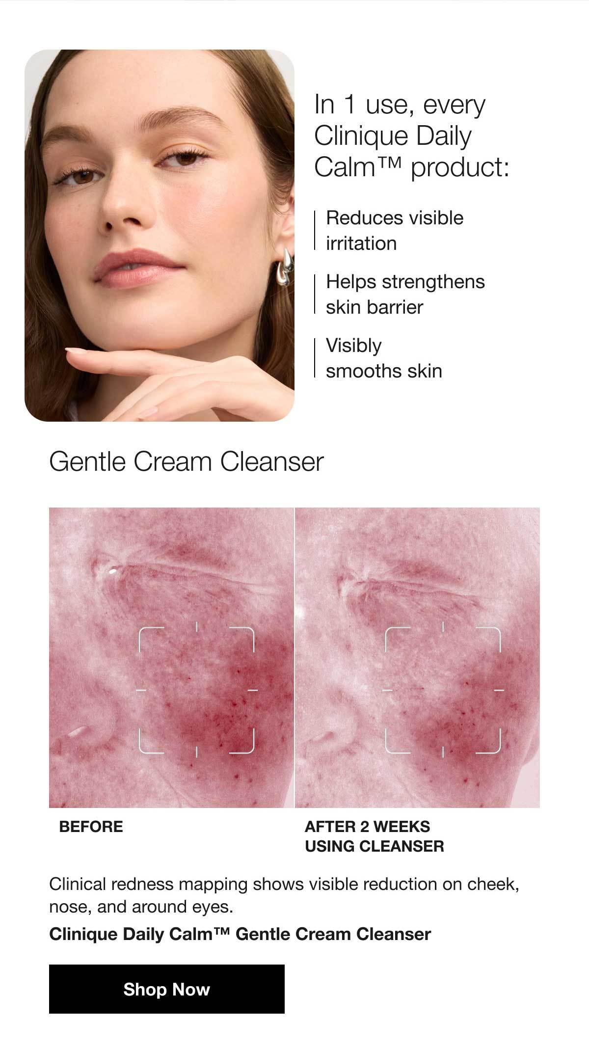 In 1 use, every Clinique Daily Calm™ product: | Reduces visible irritation | Helps strengthens skin barrier | Visibly smooths skin | Gentle Cream Cleanser | BEFORE | AFTER 2 Weeks USING Cleanser | Clinical redness mapping shows visible reduction on cheek, nose, and around eyes. Clinique Daily Calm™ Gentle Cream Cleanser | Shop Now