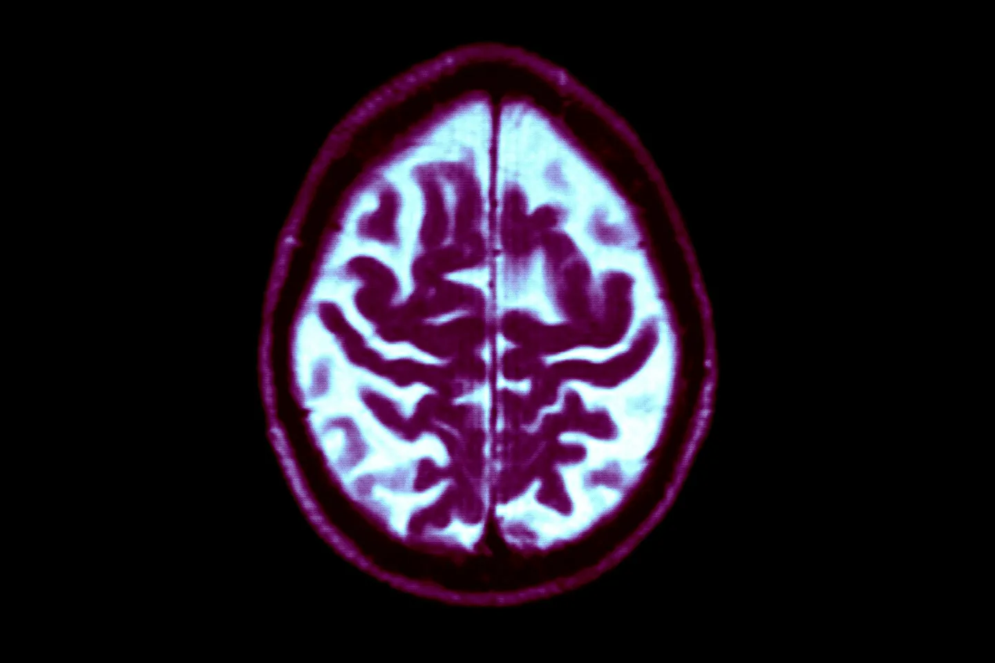A scan of a brain with Alzheimer’s. BSIP/UIG via Getty Images