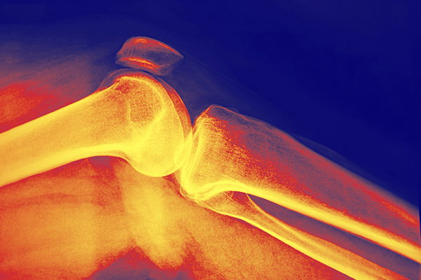 Visualization of an x-ray and bone inflammation.