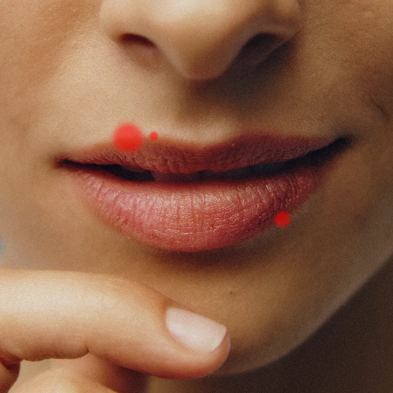Is Your Lip Pimple Actually a Cold Sore?