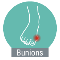 Bunions
