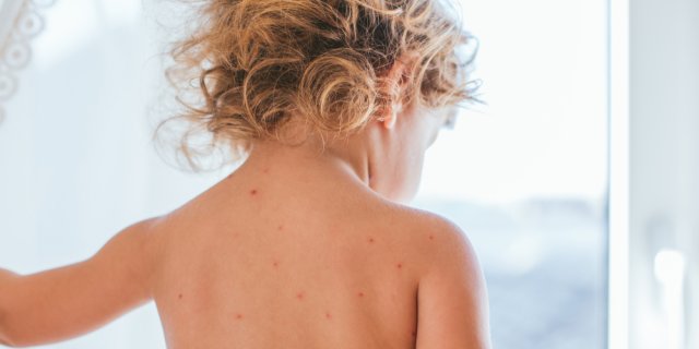 boutons de chaleur bébé