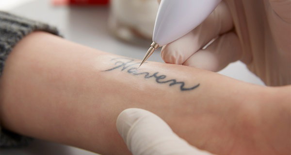 Two Tattoo Removal Sessions for Small to Large Areas (Up to 10")