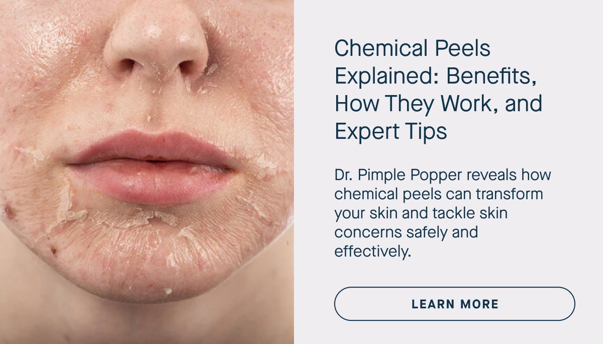 Learn More: Chemical Peels Explained