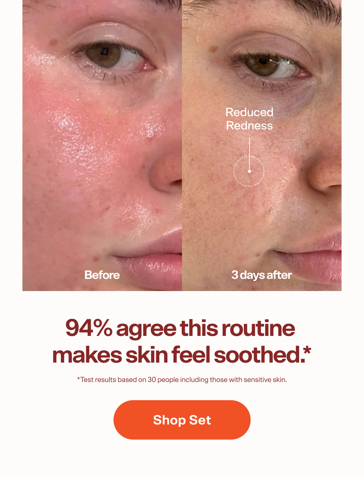 Reduced Redness Before 3 days after 94% agree this routine  makes skin feel soothed.* *Test results based on 30 people including those with sensitive skin. Shop Set