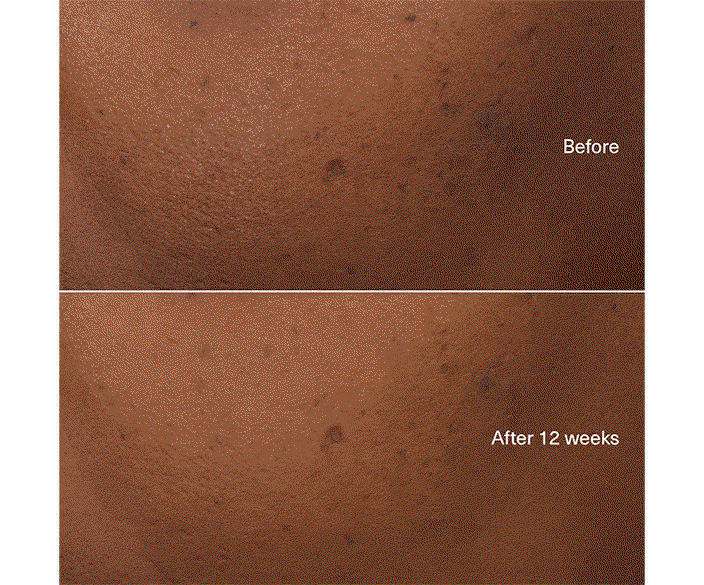Before | After 12 weeks