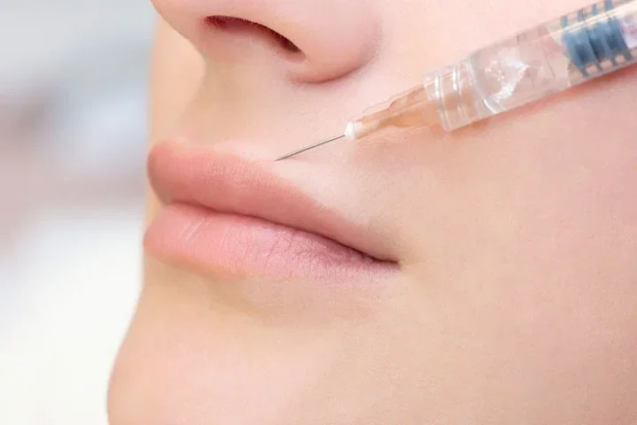 Fillers läppar 1 ml hos Mojgan Medical Clinic i Kista