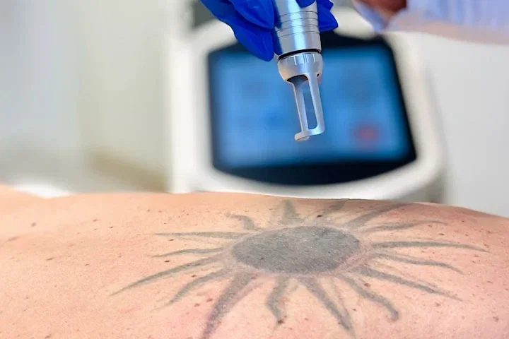 Tatueringsborttagning med laser hos Clivia Clinic på Östermalm