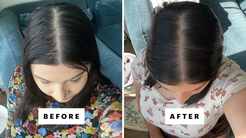 I Used PRP to Treat My Hair Loss