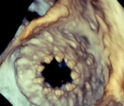 Transcatheter Tricuspid Valve Therapy