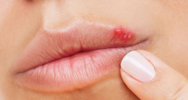 Consultation + Cold Sore & Genital Herpes Prevention - Valacyclovir