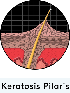 Ingrown Hairs