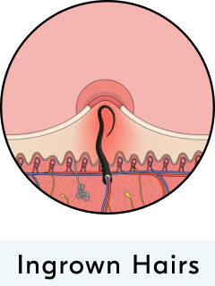 Keratosis Pilaris